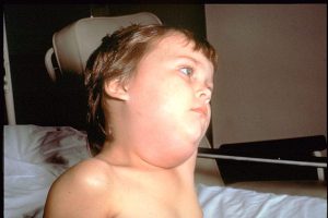 MUMPS VIRUS