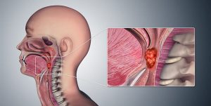 NASOPHARYNGEAL CARCINOMA