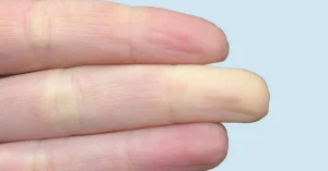 RAYNAUD SYNDROME