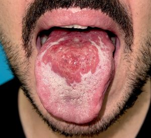LYMPHOGRANULOMA VENEREUMv