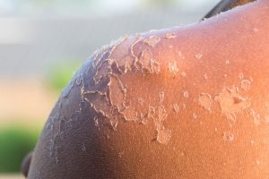 SIGNS OF SUNBURN