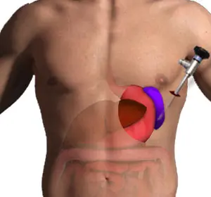SPLENECTOMY