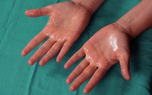 HYPERHIDROSIS