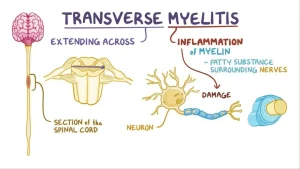 TRANSVERSE MYELITIS