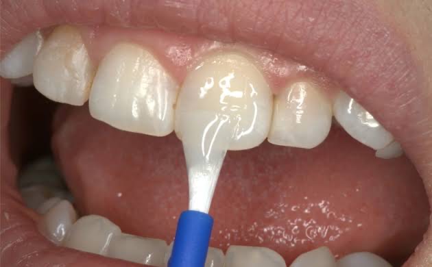 fluoride for teeth
