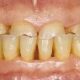 Bruxism