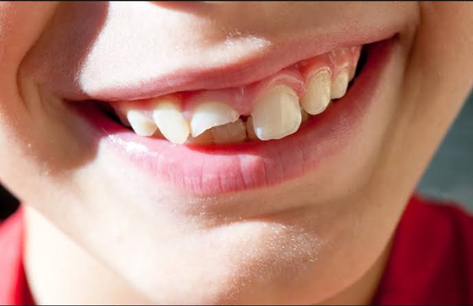 Chipped tooth