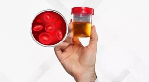 CAUSES OF MORNING RED URINE