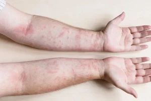 EFFECTS OF INFECTIONS AND SWEATS