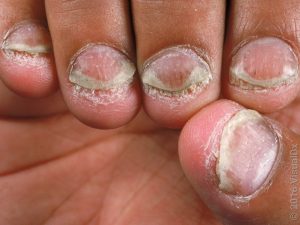 FINGERNAILS DISEASES