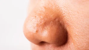 INFECTIONS AND NASAL SWELLING