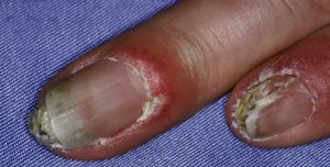 FINGERNAILS DISEASES