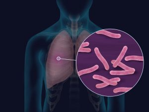 CAUSES OF CHEST DRYNESS