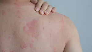HEALTH IMPACTS OF DUST