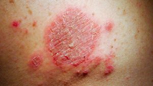 HEALTH IMPACTS OF DUST