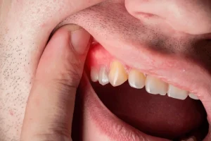 TOOTH PROBLEMS AND REMEDIES