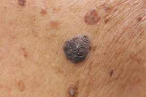 TYPES OF SKIN CANCER