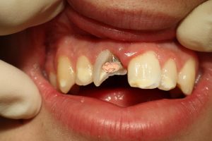 TOOTH PROBLEMS AND REMEDIES