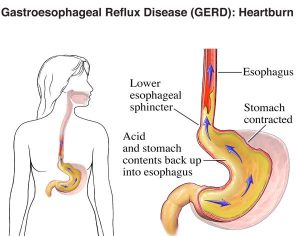 DIFFICULTY IN SWALLOWING