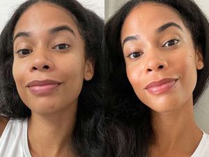 PIMPLES REMOVAL TIPS