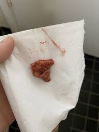 ABDOMINAL PAINS AND MISCARRIAGES