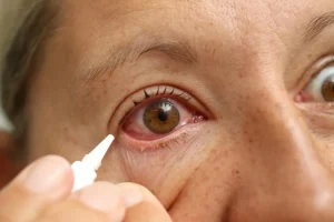 REMEDIES FOR EYE REDNESS