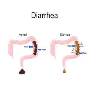 WHAT IS DIARRHEA?