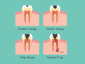 DECAY OF TOOTH