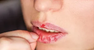 Lip breakage causes and treatments