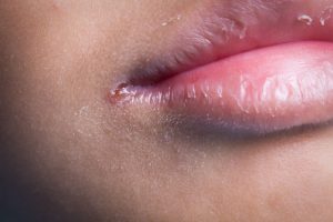 Lip breakage causes and treatments