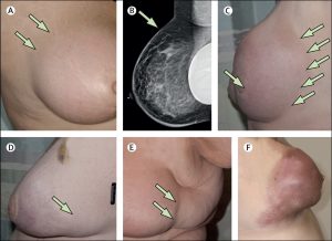 Breast lumps causes