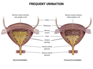CAUSES OF INCREASED URINARY FREQUENCY