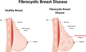 Breast lumps causes