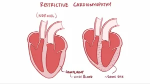 cardiomyopathy analysis