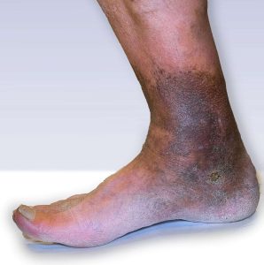 Signs of edema