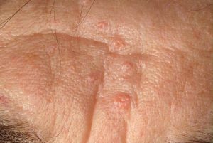 Skin and abnormal growth