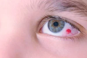 KIDS RED EYES REMEDIES