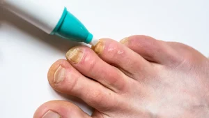 SIGNS OF FUNGAL INFECTIONS
