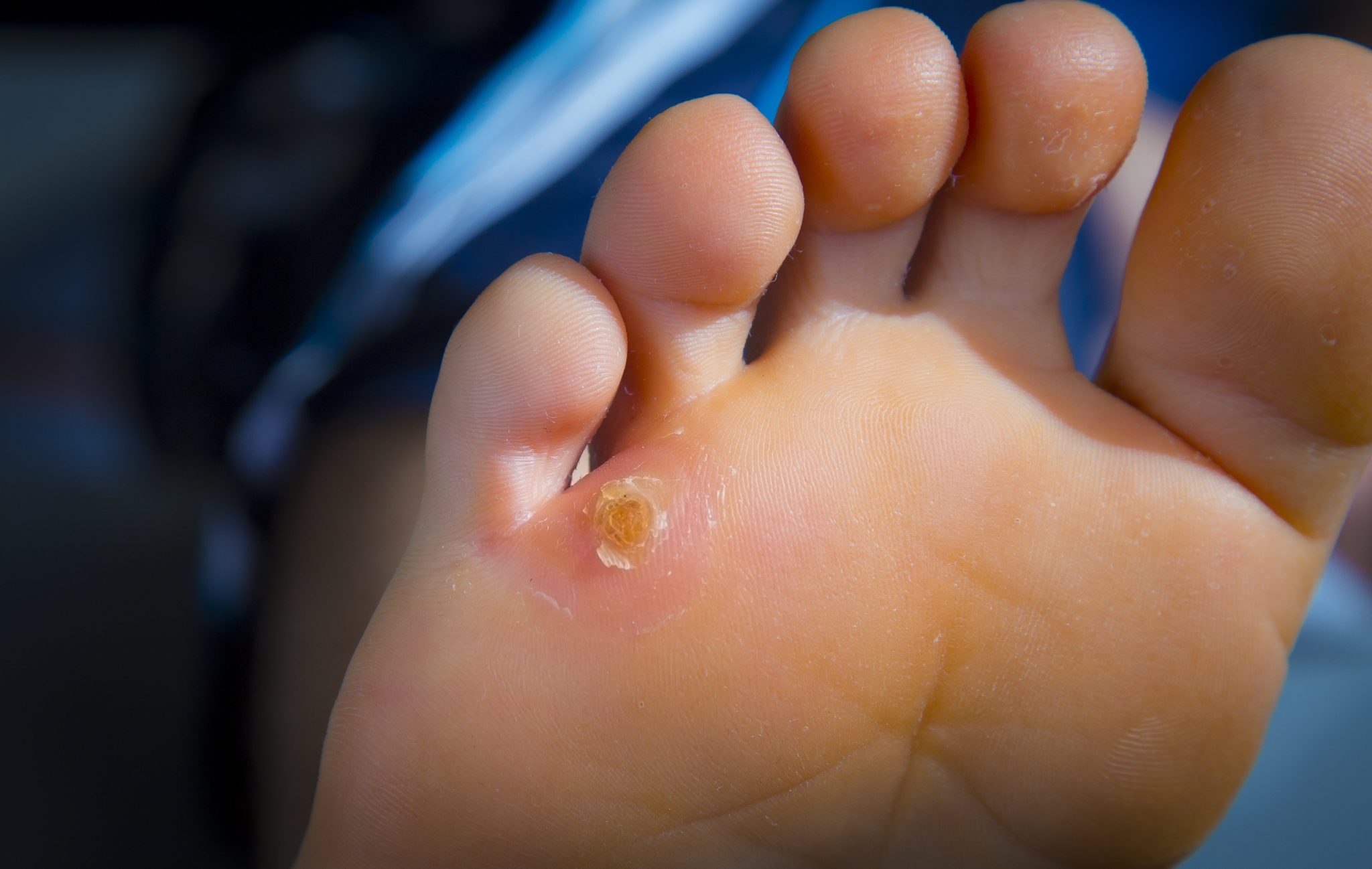 Infections Caused by Poor Hand Hygiene - SimplExplainer