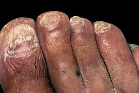 FUNGUS AND TOENAILS