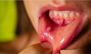 ANALYSING ORAL THRUSH