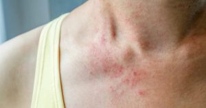 Health hazards of dust