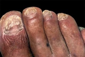 Fingernails diseases