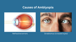HOW TO PREVENT AMBLYOPIA