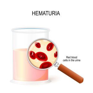 Red urine causes