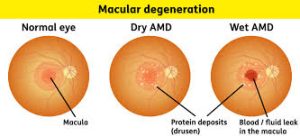 TIPS FOR DECREASING RISKS OF AMD 