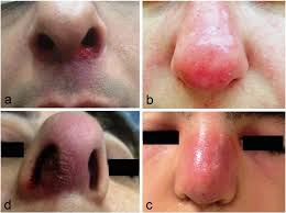 Causes of nasal swelling