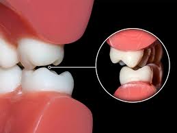 Tips for premolar tooth 