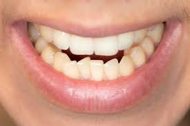 Wisdom teeth and growth processes