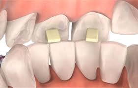 How to protect your teeth